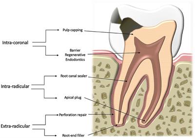 Classification of Hydraulic Cements Used in Dentistry